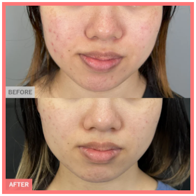 TCB東京中央美容外科 ピコフラクショナル