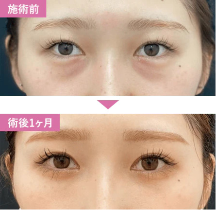 湘南美容クリニック クマ取り症例画像