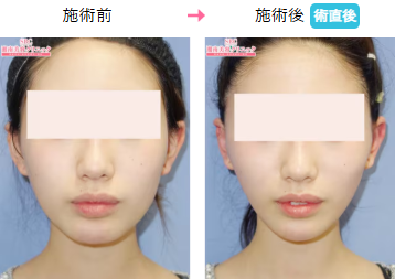 湘南美容クリニック　プリマリフト症例画像