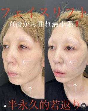 ルラ美容クリニック　フェイスリフト症例