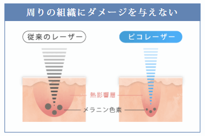 ルラ美容クリニック ピコレーザー