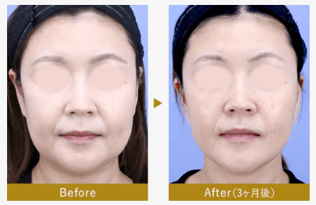 湘南美容クリニック　フェイスリフト症例