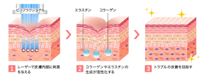 TCB東京中央美容外科 ピコフラクショナル