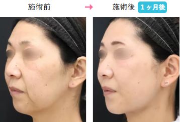 湘南美容クリニック　プリマリフト症例画像