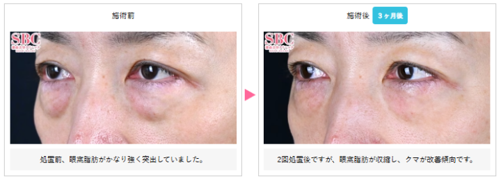 湘南美容クリニック モフィウス8症例