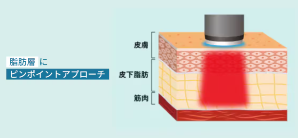湘南美容クリニック　オンダリフト