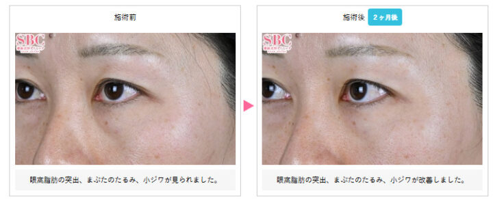 湘南美容クリニック モフィウス8症例