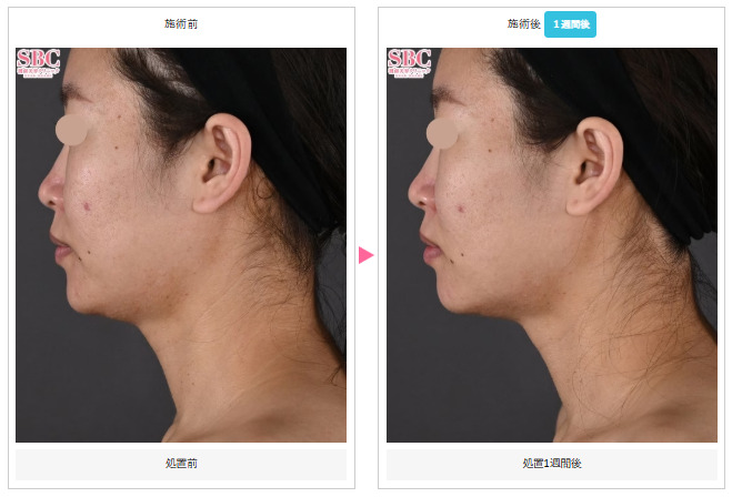 湘南美容クリニック モフィウス8症例