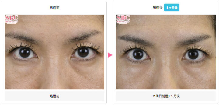 湘南美容クリニック モフィウス8症例