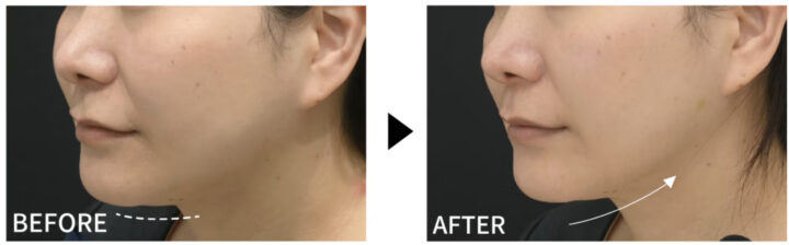 湘南美容 ボトックスリフト 症例