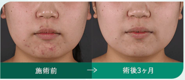 湘南美容クリニック　ベロテロリバイブ