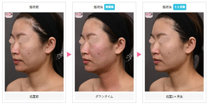 湘南美容クリニック モフィウス8症例