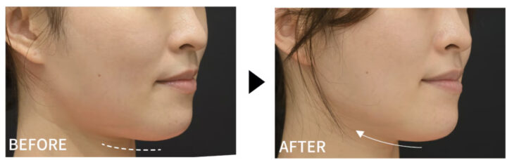 湘南美容 ボトックスリフト 症例