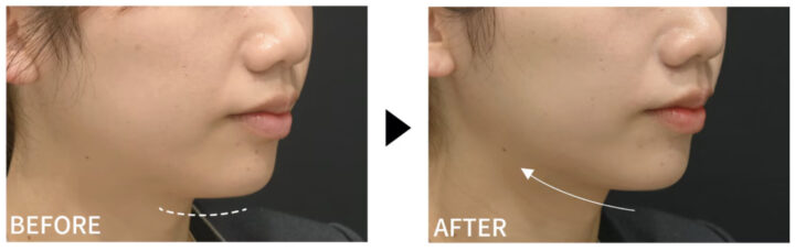 湘南美容 ボトックスリフト 症例