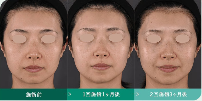 湘南美容クリニック　ベロテロリバイブ