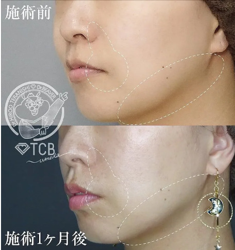 TCBハイフ症例画像