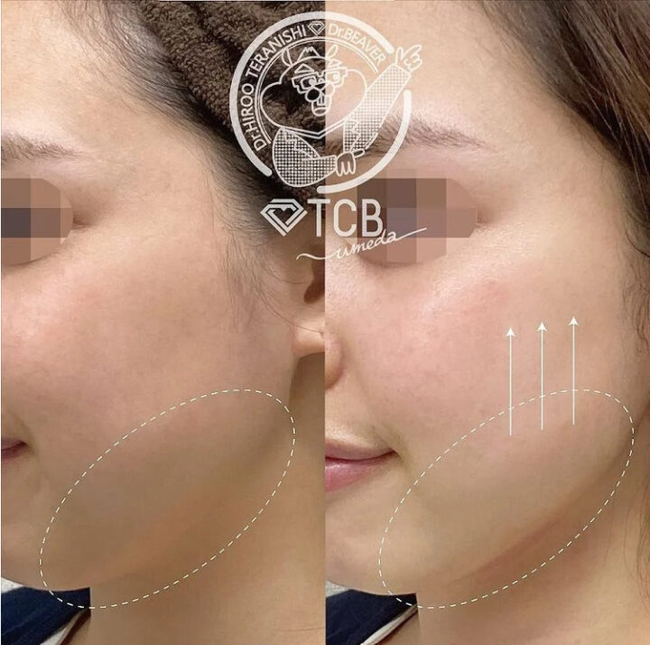 TCB_ハイフ症例画像