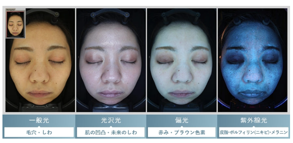 TCB東京中央美容外科　肌診断