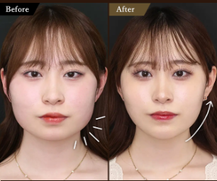 TAクリニック 糸リフト症例画像