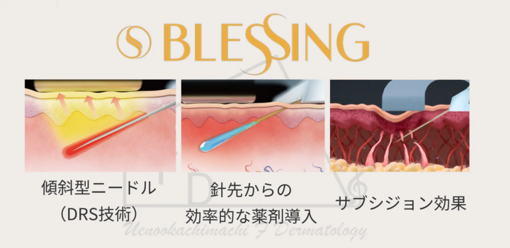 ブレッシング仕組み画像