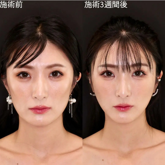 TAクリニック 糸リフト症例画像