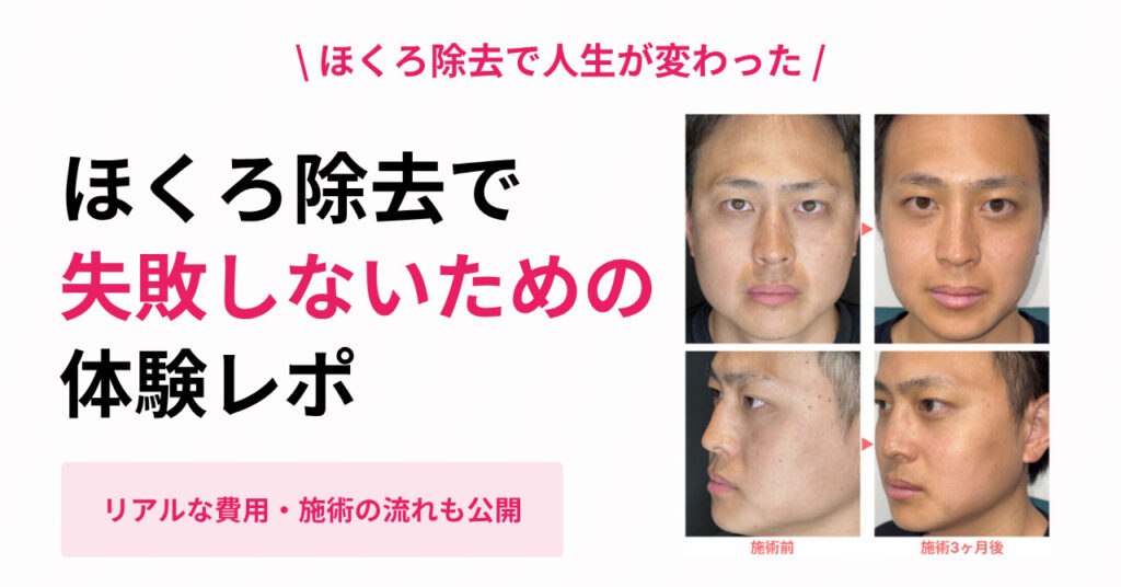 【体験談】ほくろ除去で人生が変わった話