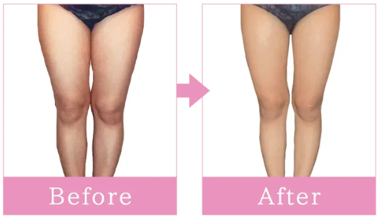 キレイサローネ　症例