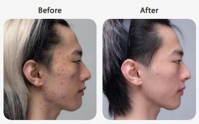 ゴリラクリニック_ポテンツァ