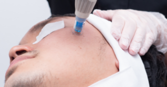 ゴリラクリニック_ダーマペン