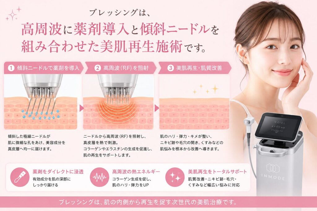 ブレッシング 仕組み